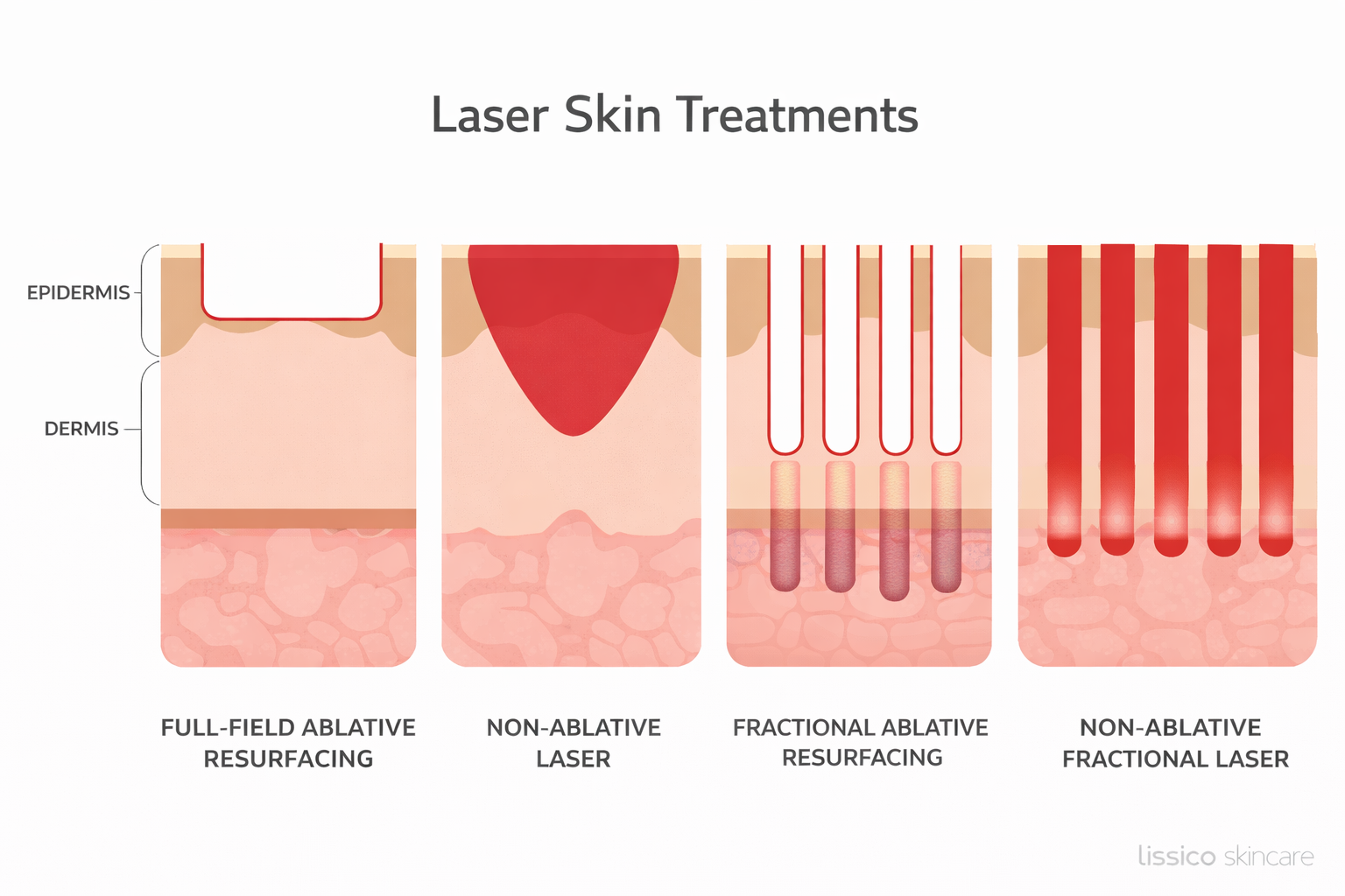 Laser Ablation vs Non-Ablative Laser Treatments: A Dermatologist’s Per ...